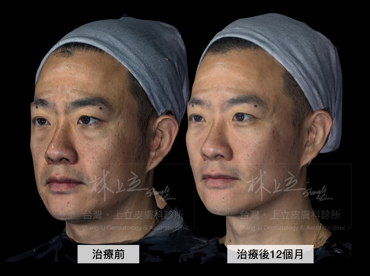 男性淚溝的治療案例，從治療前的照片中可見他一樣有很明顯的淚溝，臉部輪廓也因為顴骨和上顎骨的流失變得不夠立體