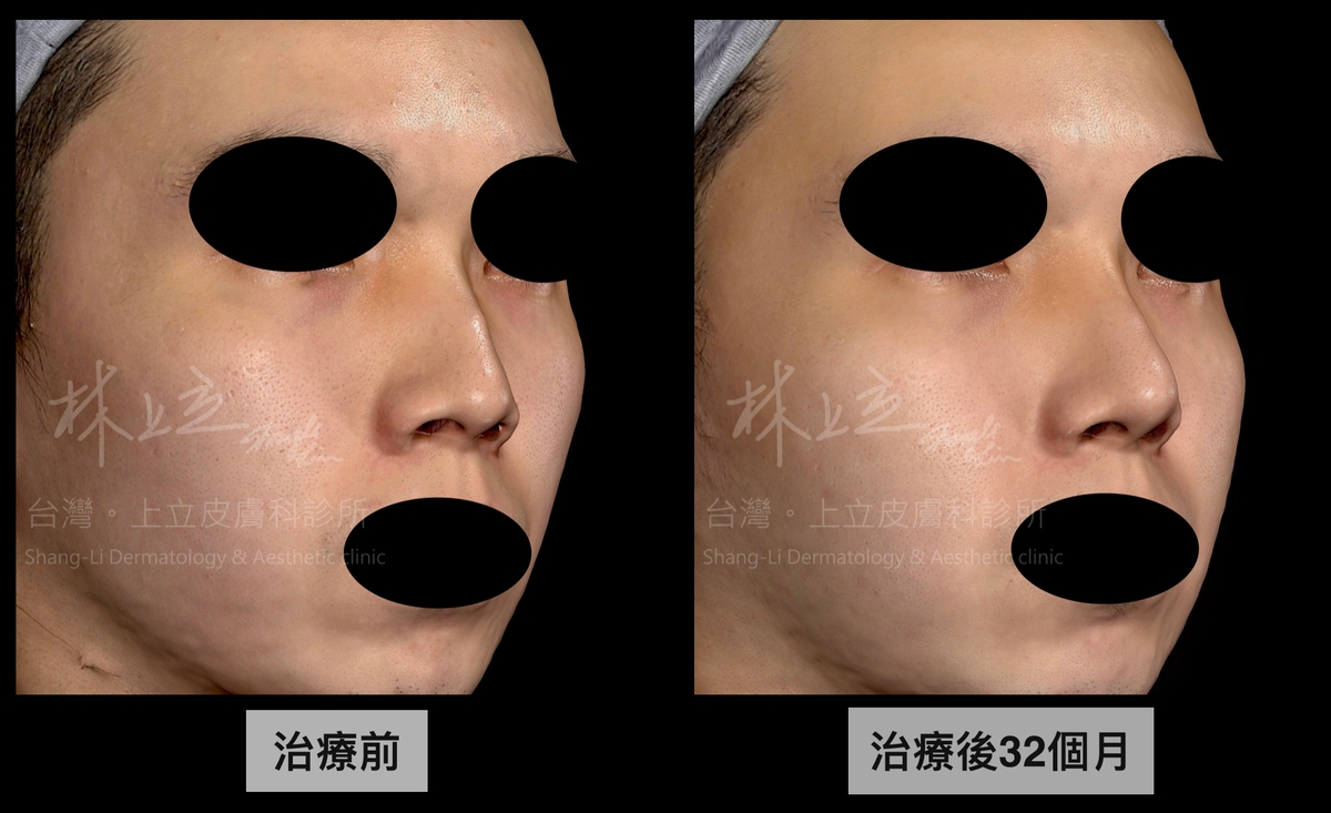 ELLANSÉ洢蓮絲隆鼻來增加鼻子的挺度，並修飾鼻梁曲線和駝峰