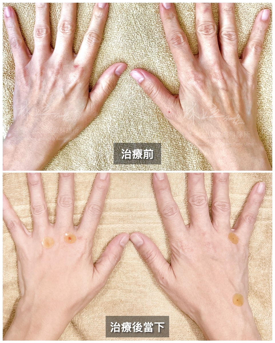 ELLANSÉ洢蓮絲，快速恢復手部肌膚的豐盈感，改善原先指節凸出、手臂乾癟