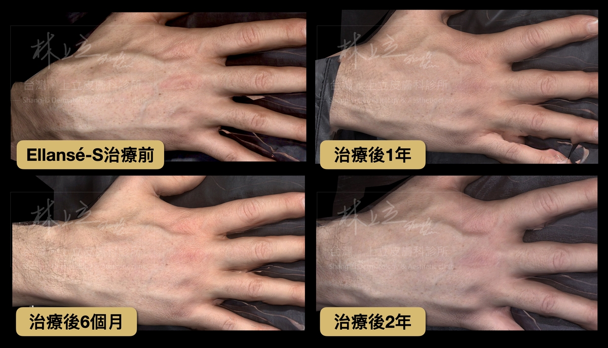 ELLANSÉ洢蓮絲可以刺激手部肌膚，不會因為手部動作被快速流失而失去治療效果