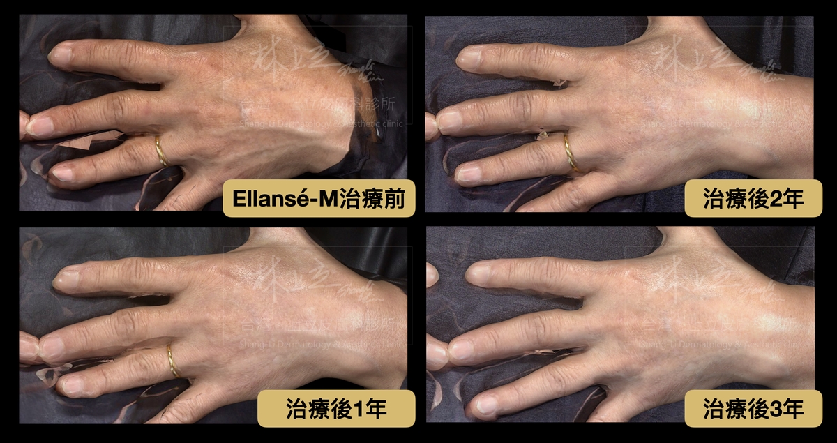 注射ELLANSÉ洢蓮絲Ｍ劑型，可見在治療後2年內，手部膚質狀態還在不斷進步