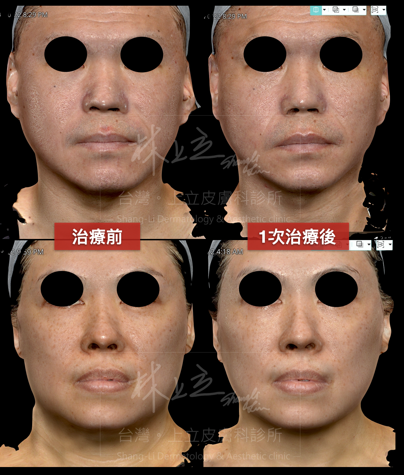 治療後提升，皮膚的緊實度，讓臉部輪廓更加緊緻俐落。 