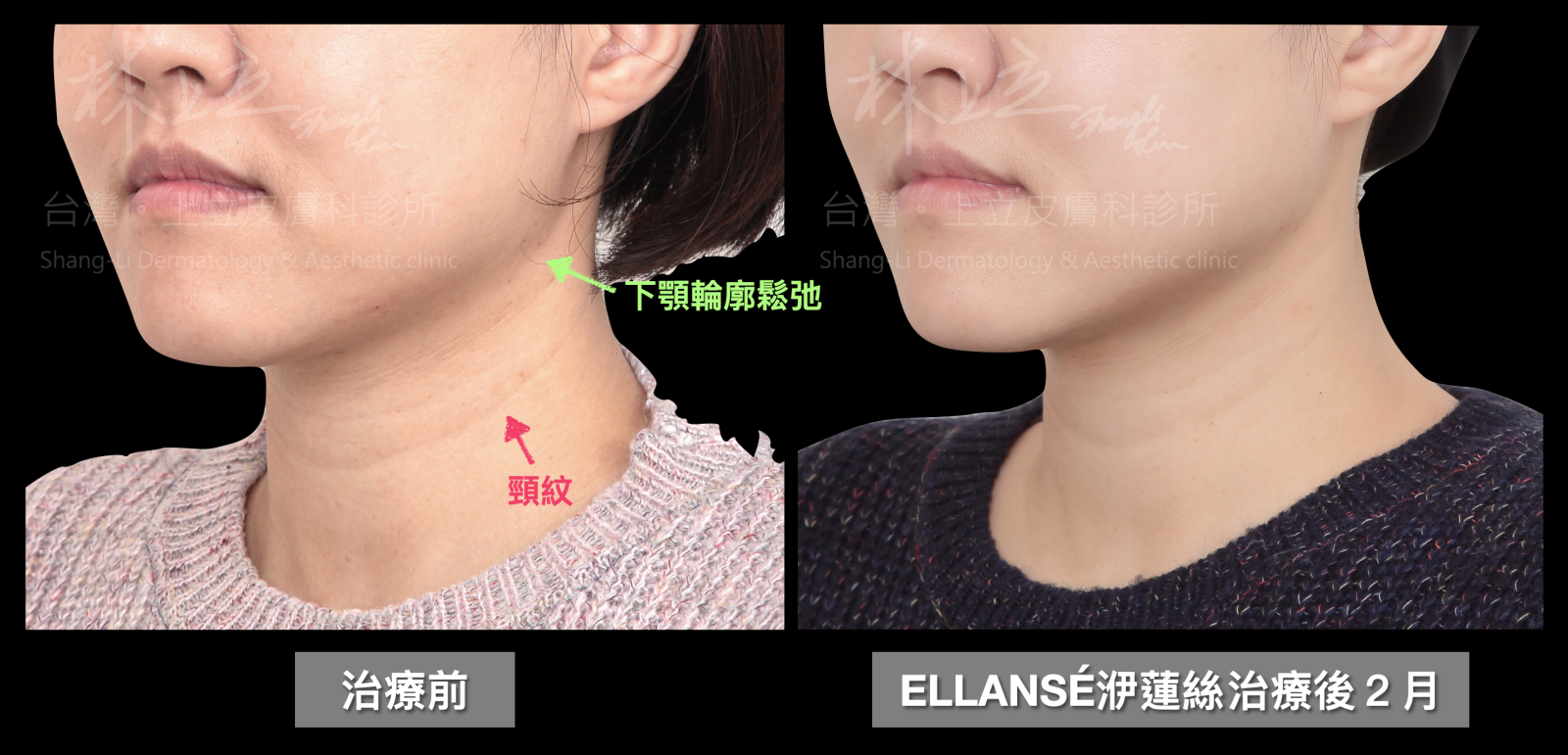ELLANSÉ洢蓮絲來重建支撐，讓下顎輪廓恢復鮮明、俐落線條