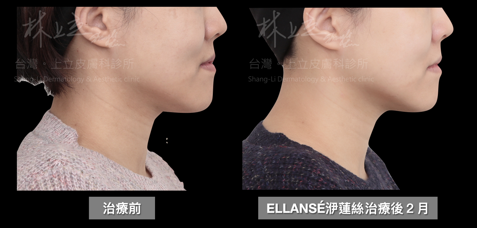 使用ELLANSÉ洢蓮絲治療兩個月後，下顎線條更為俐落，下巴處產生的輕微脂肪堆積也跟著變小