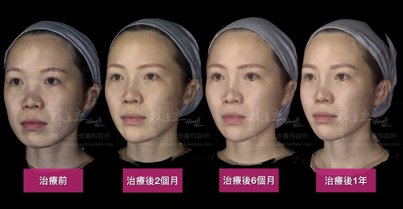 利用AestheFill艾麗斯治療，全臉輪廓更加精緻和立體，在治療後２個月就看見明顯改善