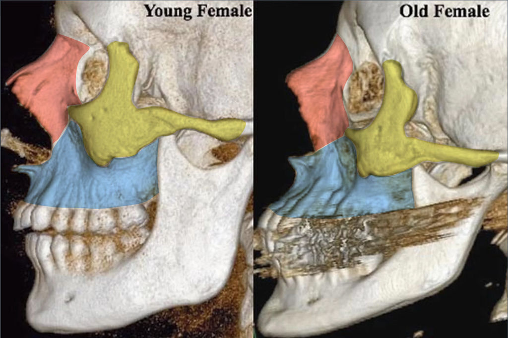 骨架的體積流失、支撐力變差，連帶改變五官形狀和臉型比例