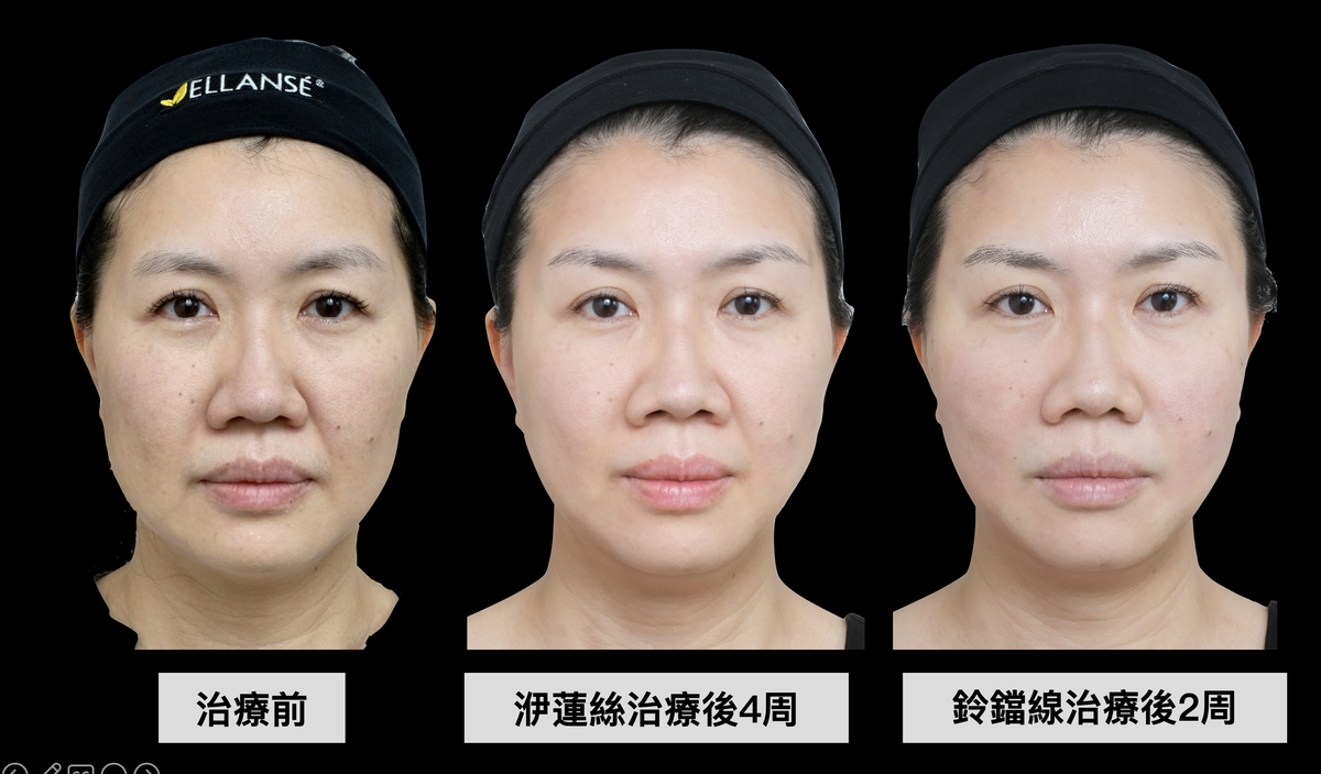 演講中，林上立醫師以亞洲女性的老化治療為範例，分享ELLANSÉ 洢蓮絲和Silhouette InstaLift鈴鐺線治療成效