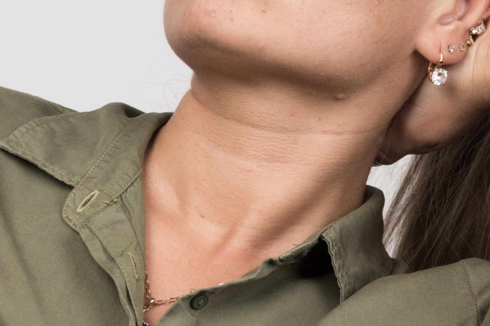 橫向頸紋和掌紋有些相似，它是我們的皮下脂肪和皮膚構造中的一些「分節」位置
