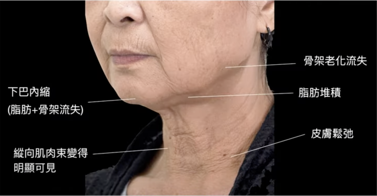 臉部和頸部皮膚的老化通常是相互關聯的，並且彼此可能相互影響，所以臉部的老化也會直接影響到頸紋的形態和嚴重程度