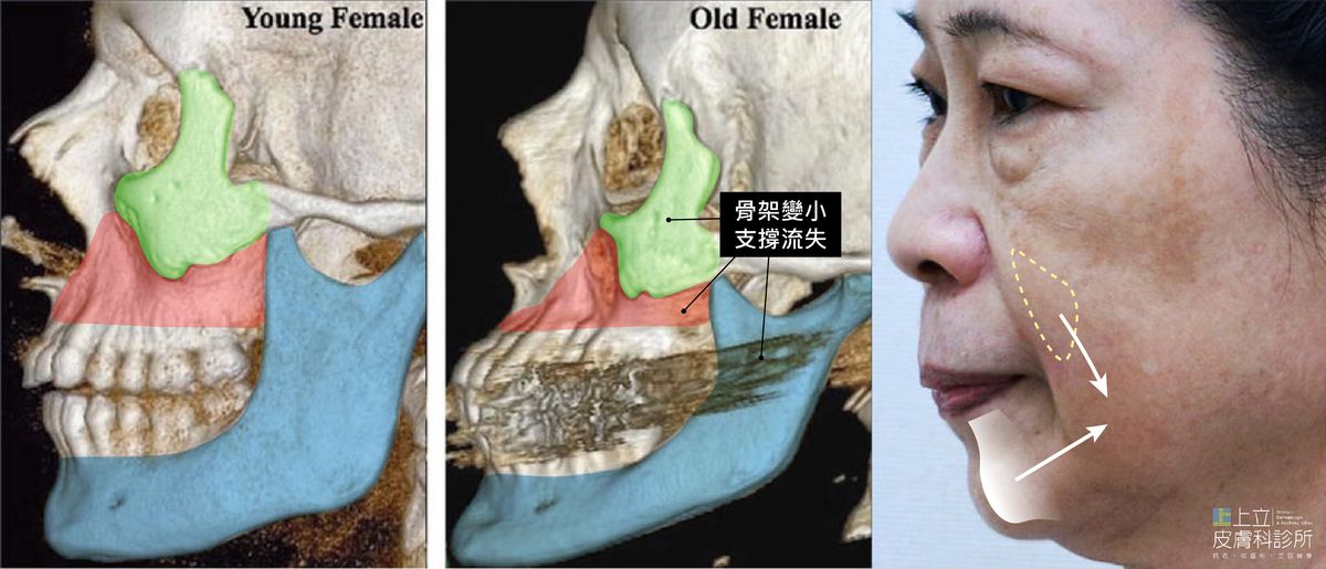 骨架就像是臉部的軸心，當骨架因老化流失而體積減少，造成軸心偏移