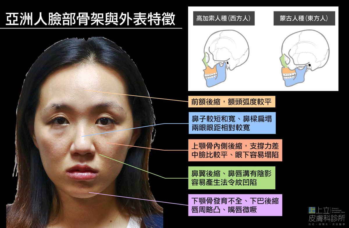 亞洲人因為天生基因的緣故，上顎骨內側比較後縮、下顎骨發育不全