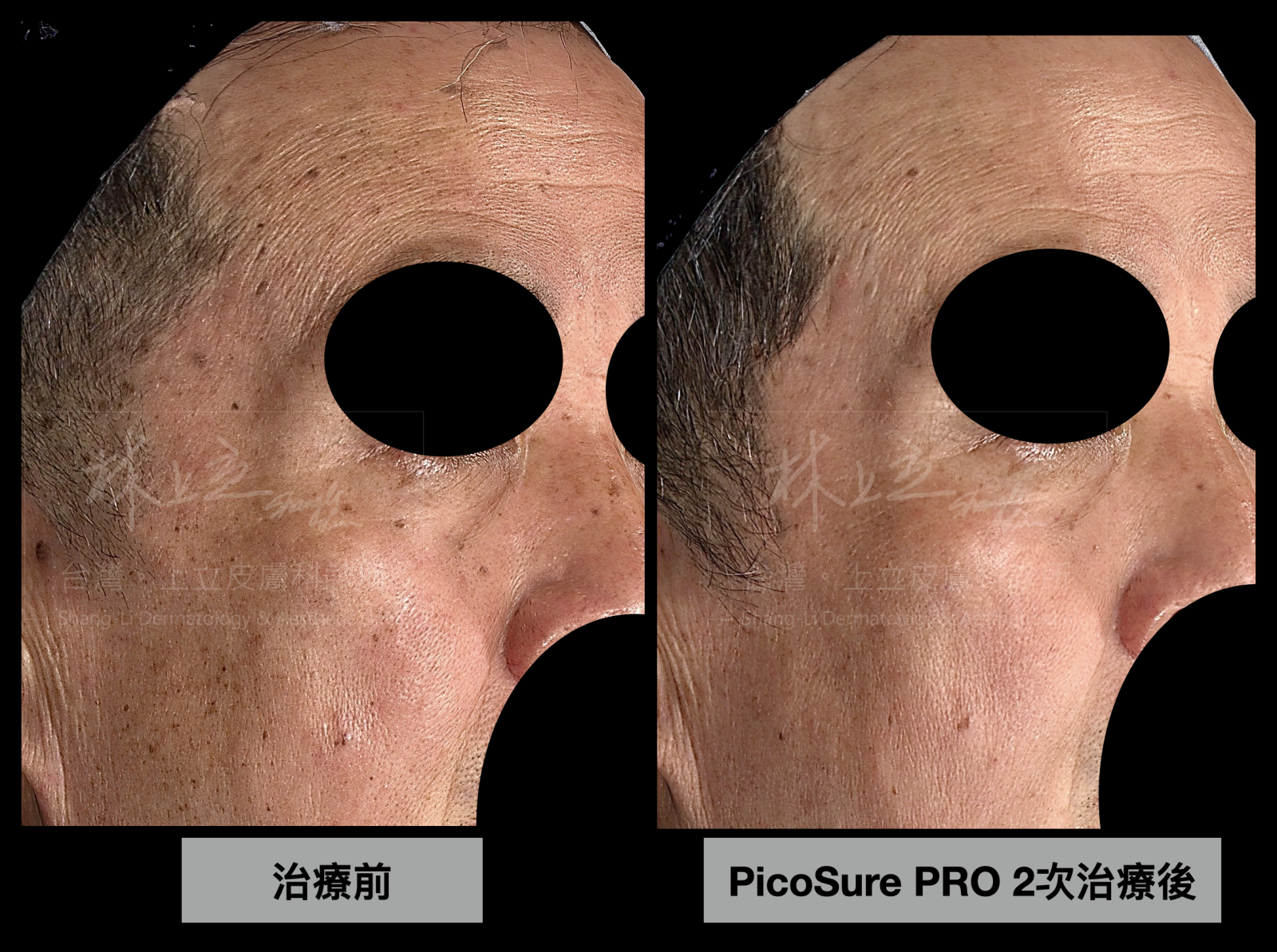 PicoSure PRO鉑金蜂巢皮秒用於曬斑一樣有很好的治療成效