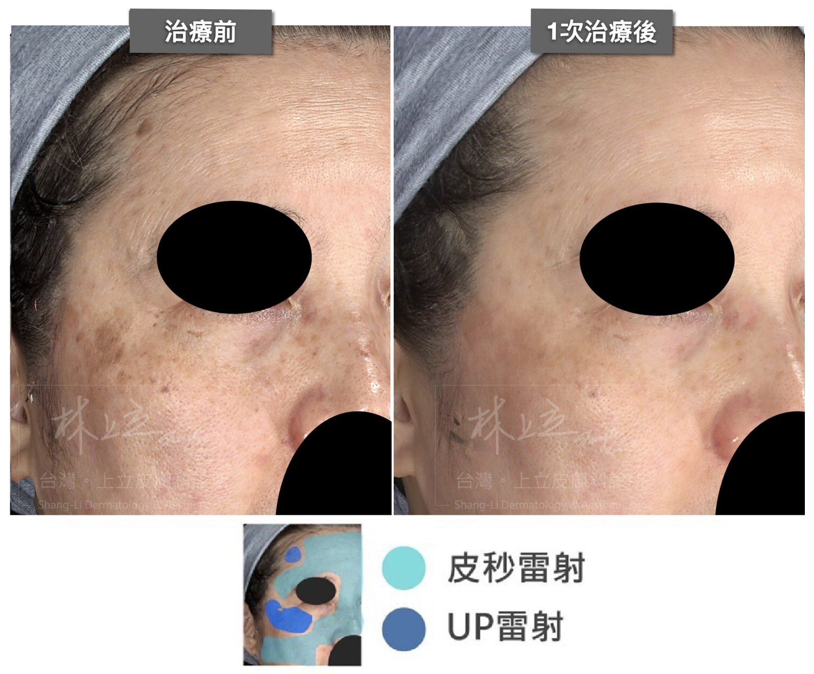 林上立醫師建議依照臉部狀況劃分出不同治療區塊，結合皮秒雷射和局部的UP雷射一起施打