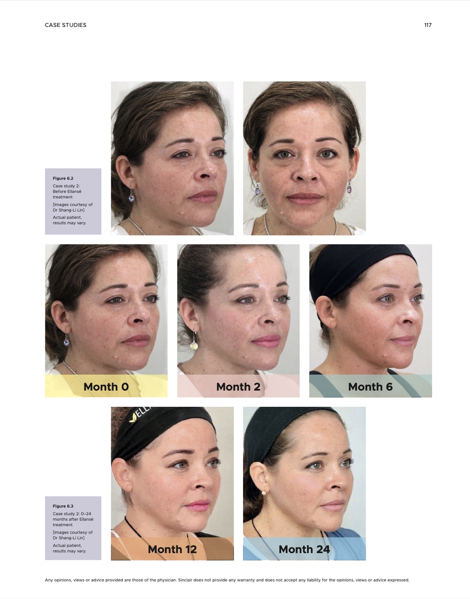 ELLANSÉ洢蓮絲-Ｍ的膠原蛋白新生時間長達2年，期間可以感受到整體臉部狀態一直持續進步