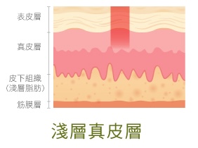 皮秒雷射 淺層真皮層