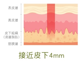 up雷射 接近皮下4mm