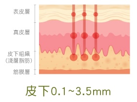 精靈電波 皮下0.1~3.5mm