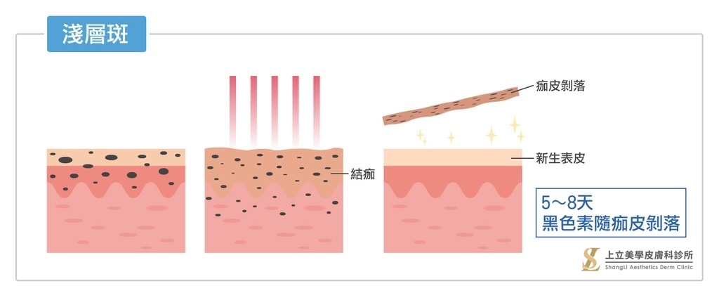 由於淺層斑的黑色素會經由表皮代謝、剝落，所以在雷射術後一定會有痂皮產生，這是雷射除斑的必經過程。