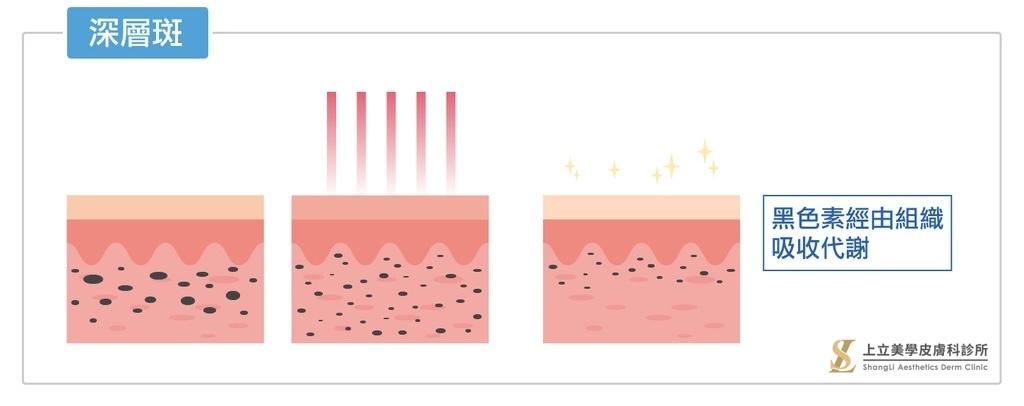 深層班的黑色素經由組織吸收代謝，不會在表層產生痂皮