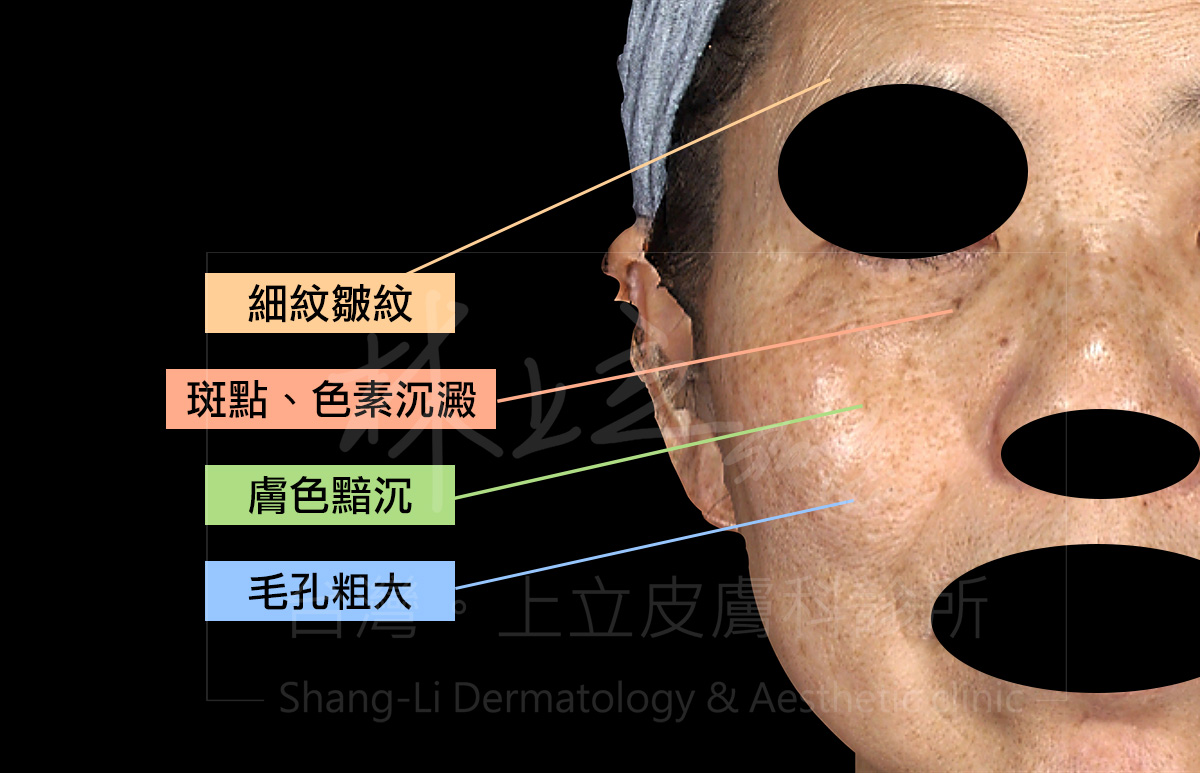 皮秒雷射效果主要的適應症為斑點、暗沉、細紋、毛孔粗大等