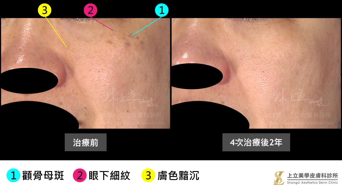 PicoSure755蜂巢皮秒雷射治療後2年的皮膚還是很乾淨，顴骨母斑在被去除之後沒有再長出來，眼下細紋消失了