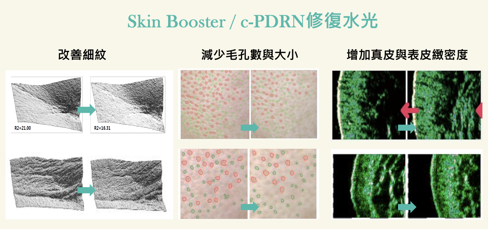 在使用了Rejuran麗珠蘭PDRN修復水光之後，連同皮膚質地也有明顯進步