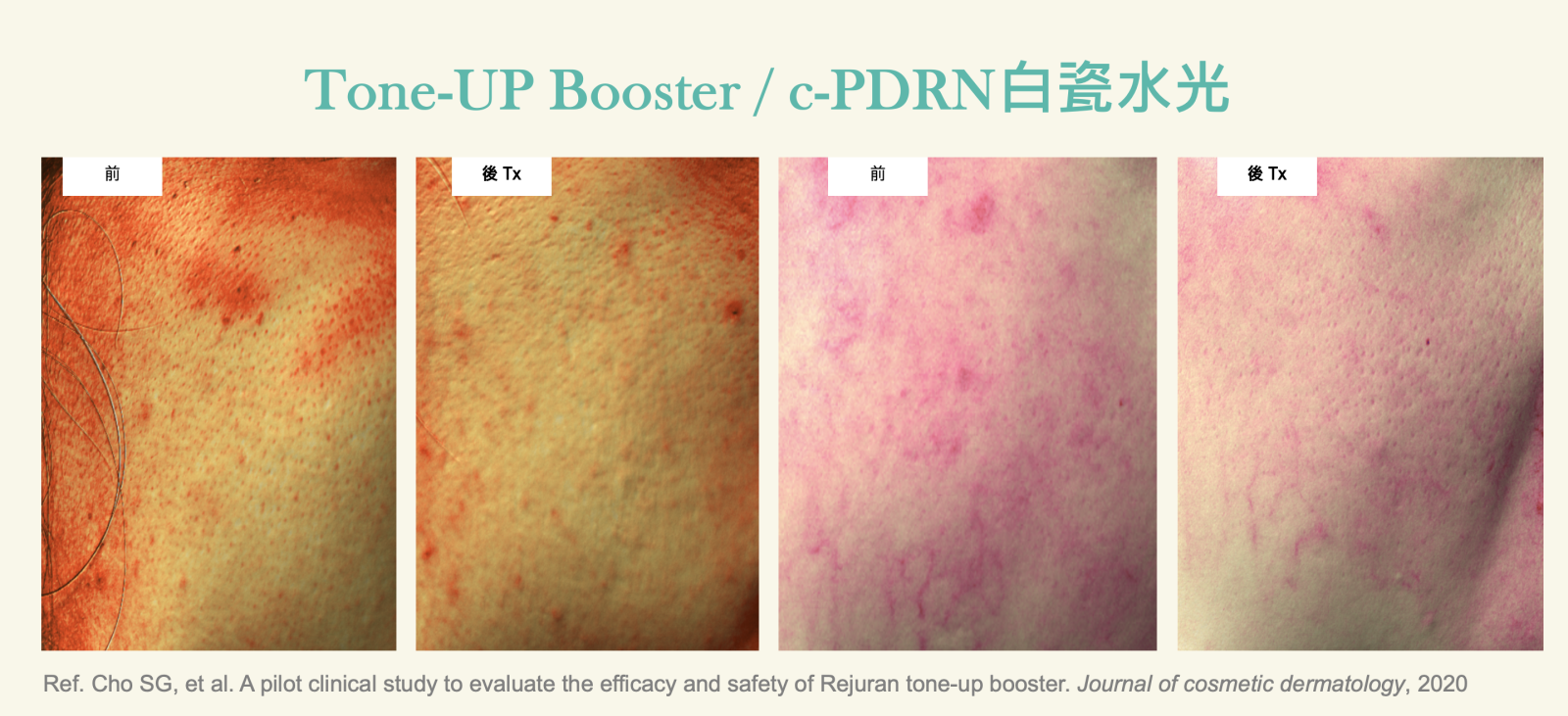 Rejuran麗珠蘭PDRN白瓷水光的專長在於表皮色素的改善