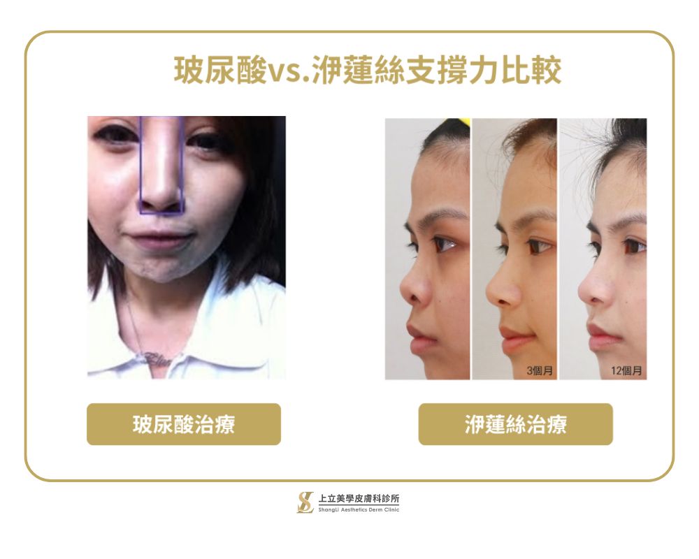 傳統玻尿酸隆鼻效果差，容易外擴讓鼻形變塌、山根變寬；洢蓮絲隆鼻子效果好，同時可以維持2~4年
