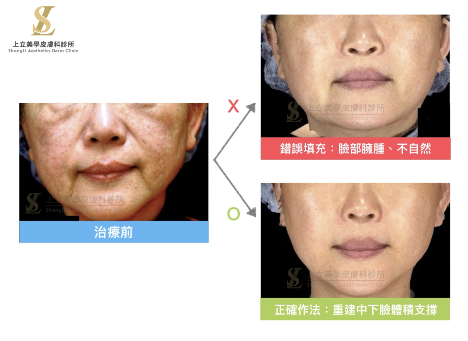 臉部會不會「饅化」的關鍵，其實取決於注射的深度和位置