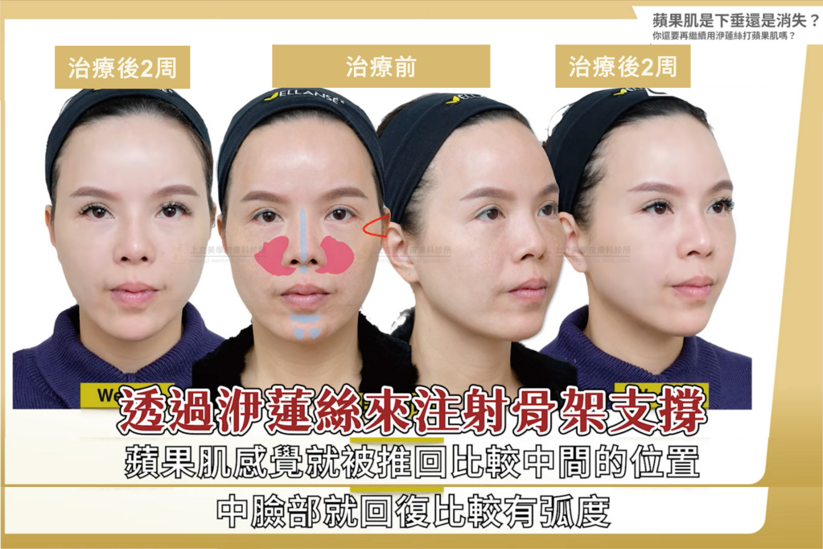 由於上顎骨的老化造成兩頰缺乏立體度，蘋果肌逐漸往外側下滑