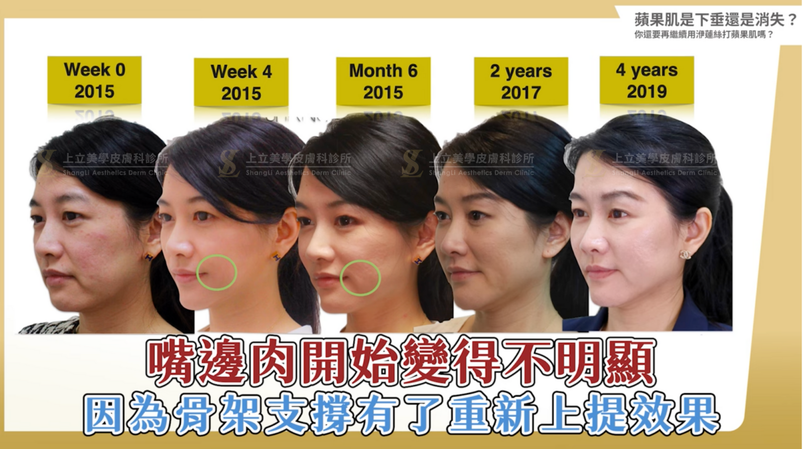 在注射ELLANSÉ洢蓮絲增加中臉的骨架支撐後，不僅蘋果肌被往上拉提、恢復立體度，就連嘴邊肉也會減少許多