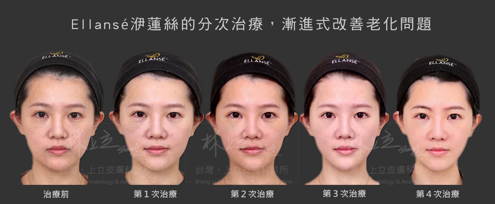 透過分次治療，漸進式改善老化問題