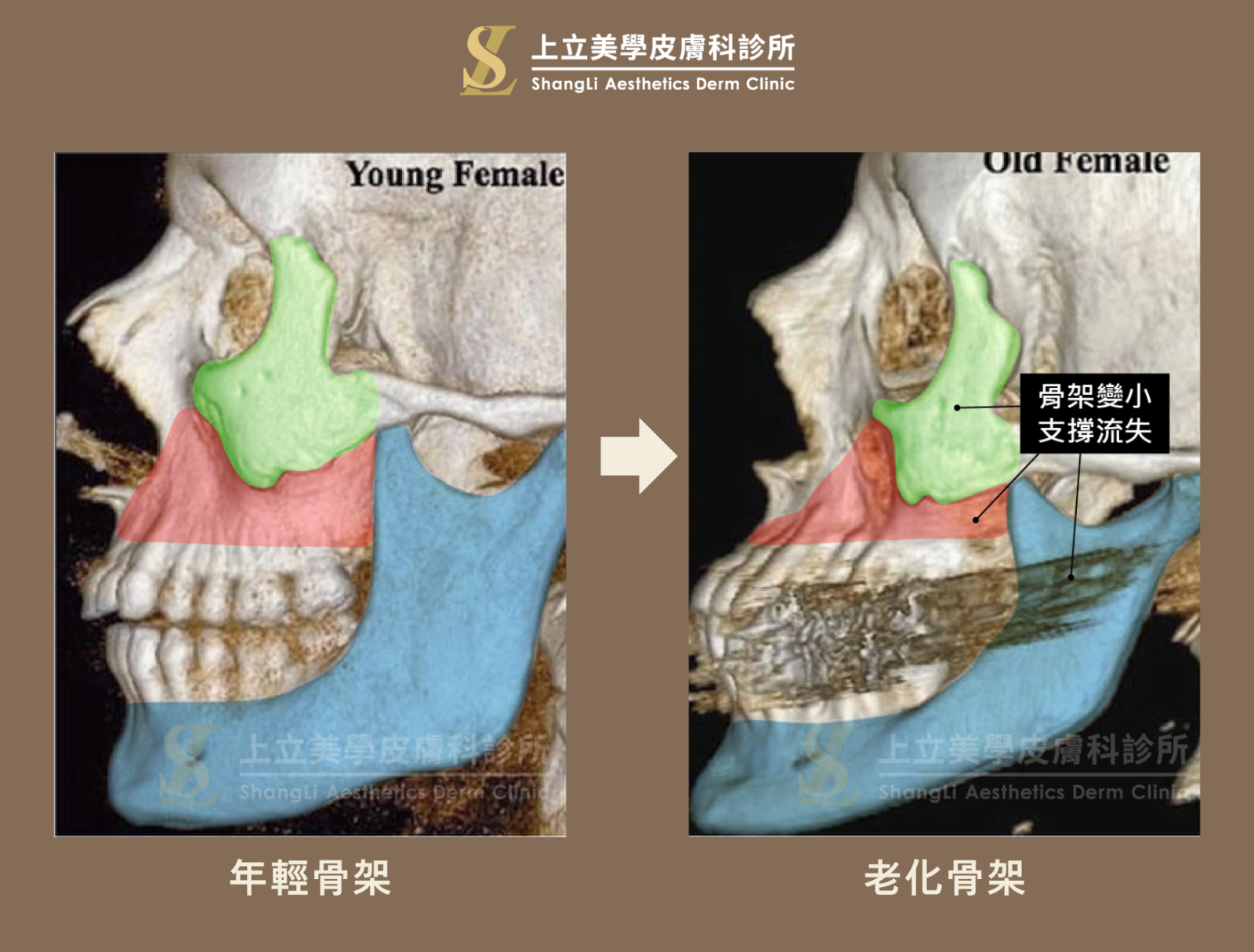 一份研究資料比較年輕和老化後的骨架