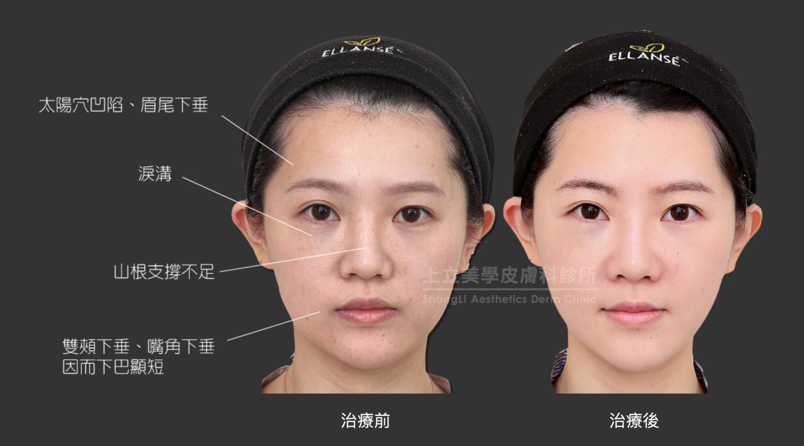 林上立醫師運用Ellansé洢蓮絲來增加山根的支撐，並改善淚溝和眼尾、雙頰、嘴角下垂的問題