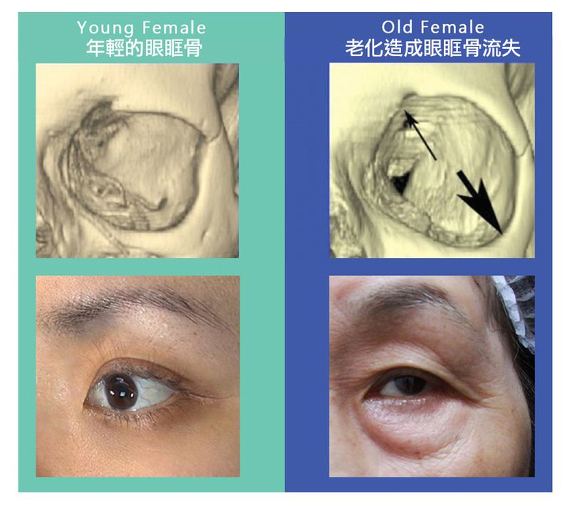 當眼眶骨因為老化流失而改變形狀，造成中央的凹洞逐漸擴大