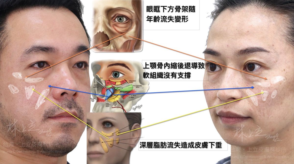 ▲淚溝是整個眼周流失的產物，牽涉到上顎骨、眼下骨架、深層脂肪的整體流失，造成原本支撐皮膚的結構鬆動、組織下滑，最終於眼下形成一道凹陷陰影。