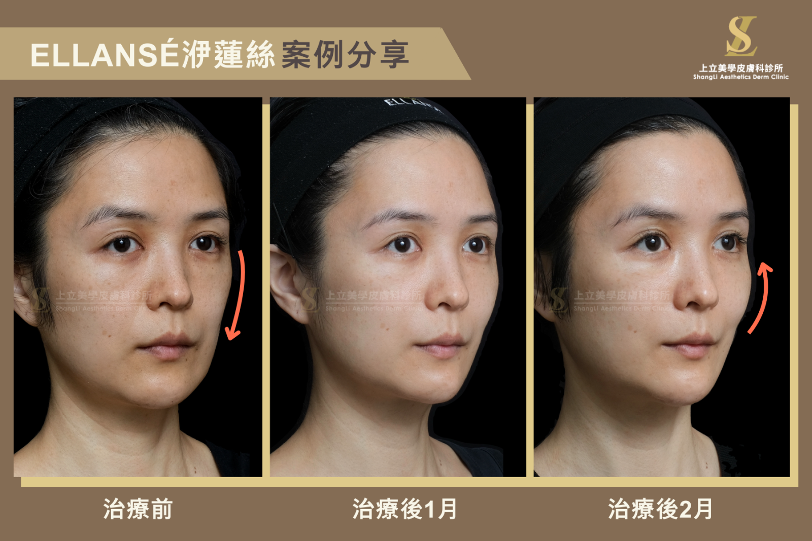使用Ellansé洢蓮絲的治療案例，由於支撐性很高，相當適合用於深層的骨架支撐來改善下滑的蘋果肌。