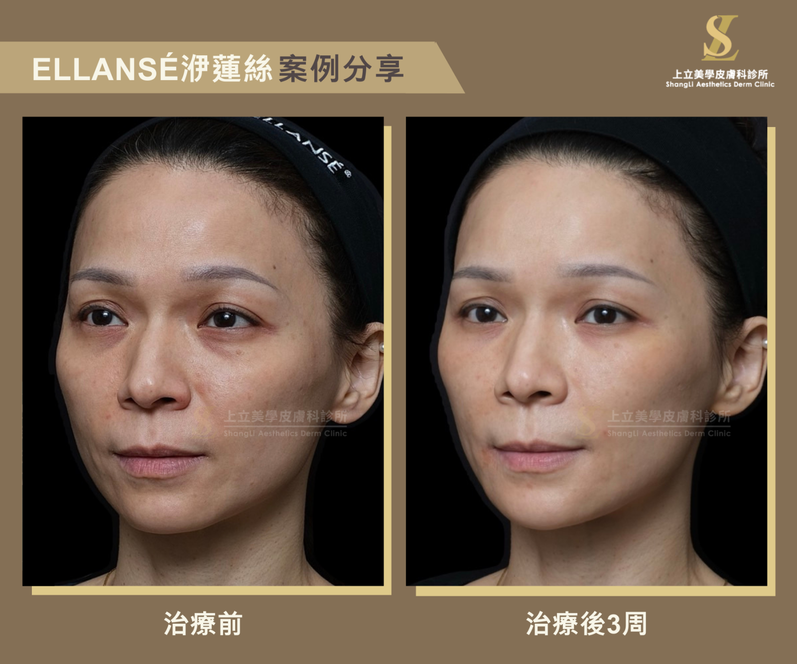 求診者的上顎骨退縮、眼眶下骨架流失凹陷，整體臉型失去立體度，也導致淚溝和法令紋明顯、蘋果肌下滑、雙頰凹陷