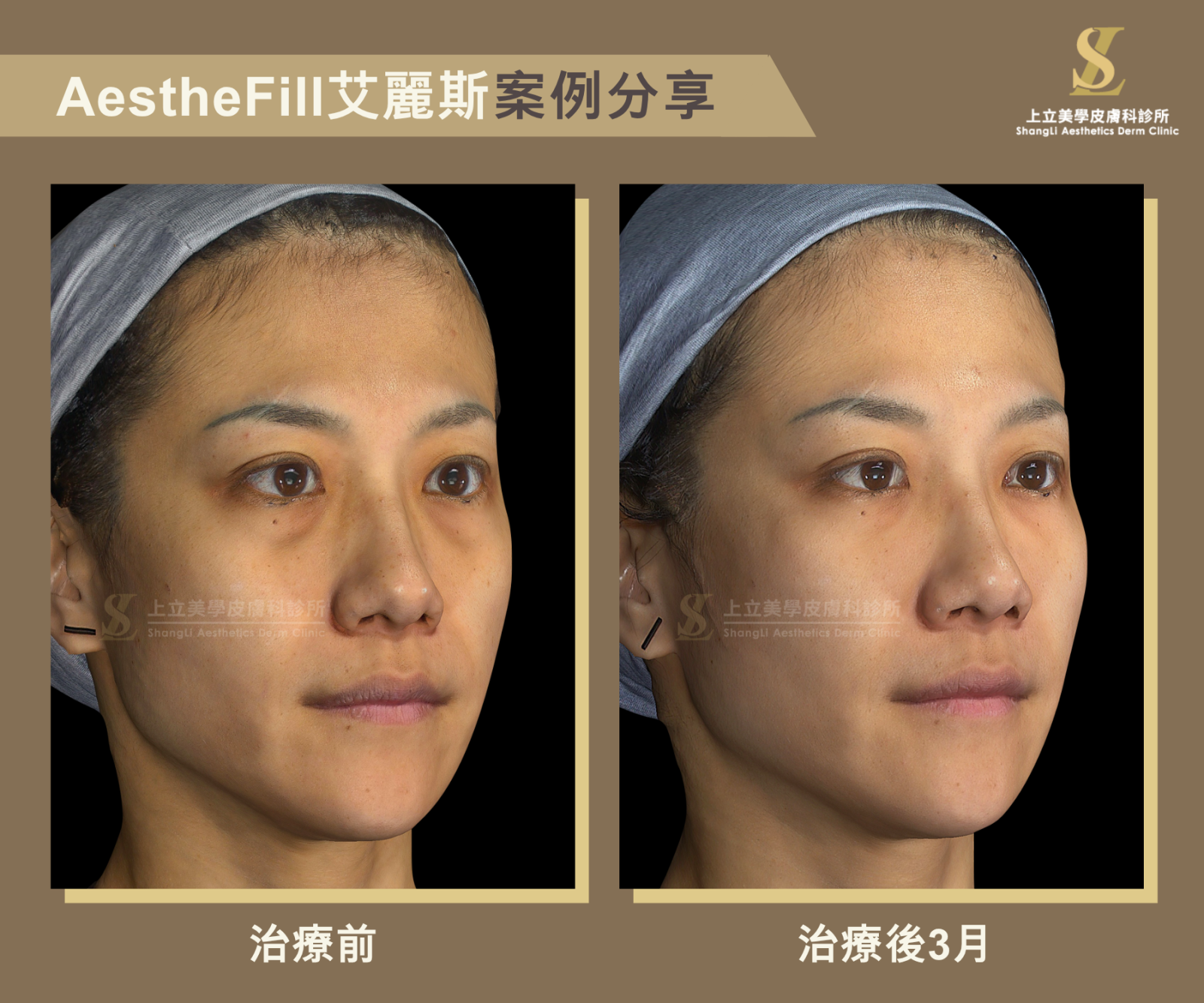 使用AestheFill艾麗斯來治療，只要將它們正確注射在對的深度、對的點位、對的劑量上，一樣能達到自然淡化淚溝和黑眼圈的效果