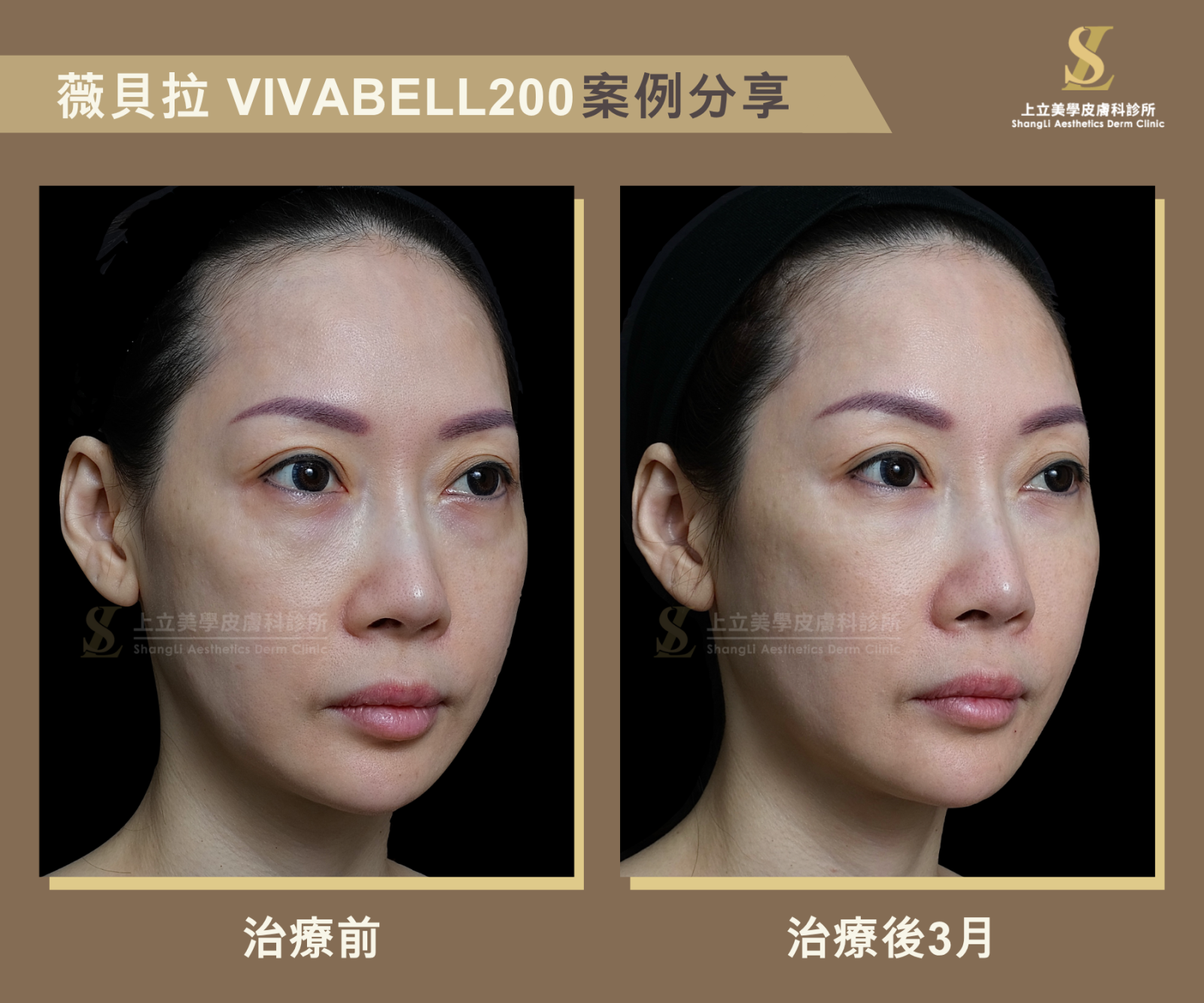 VIVAEELLA薇貝拉，淚溝治療的注射案例。由於它需要一段時間的膠原蛋白生長，我們直接來比較治療後3個月、成效漸趨完整時的狀態。
