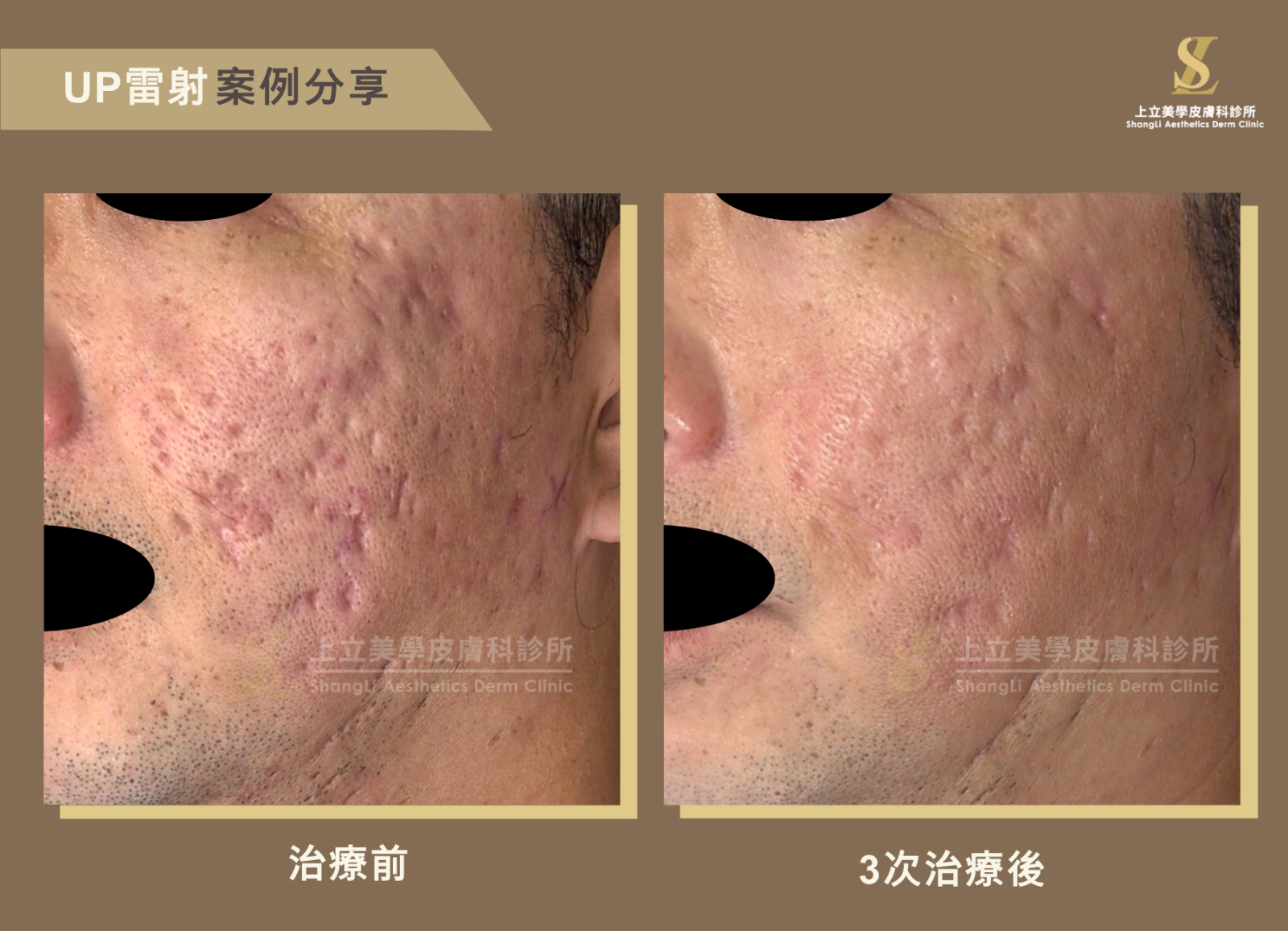 UP雷射採用10600nm波長，搭配「UltraPulse極速脈衝科技」