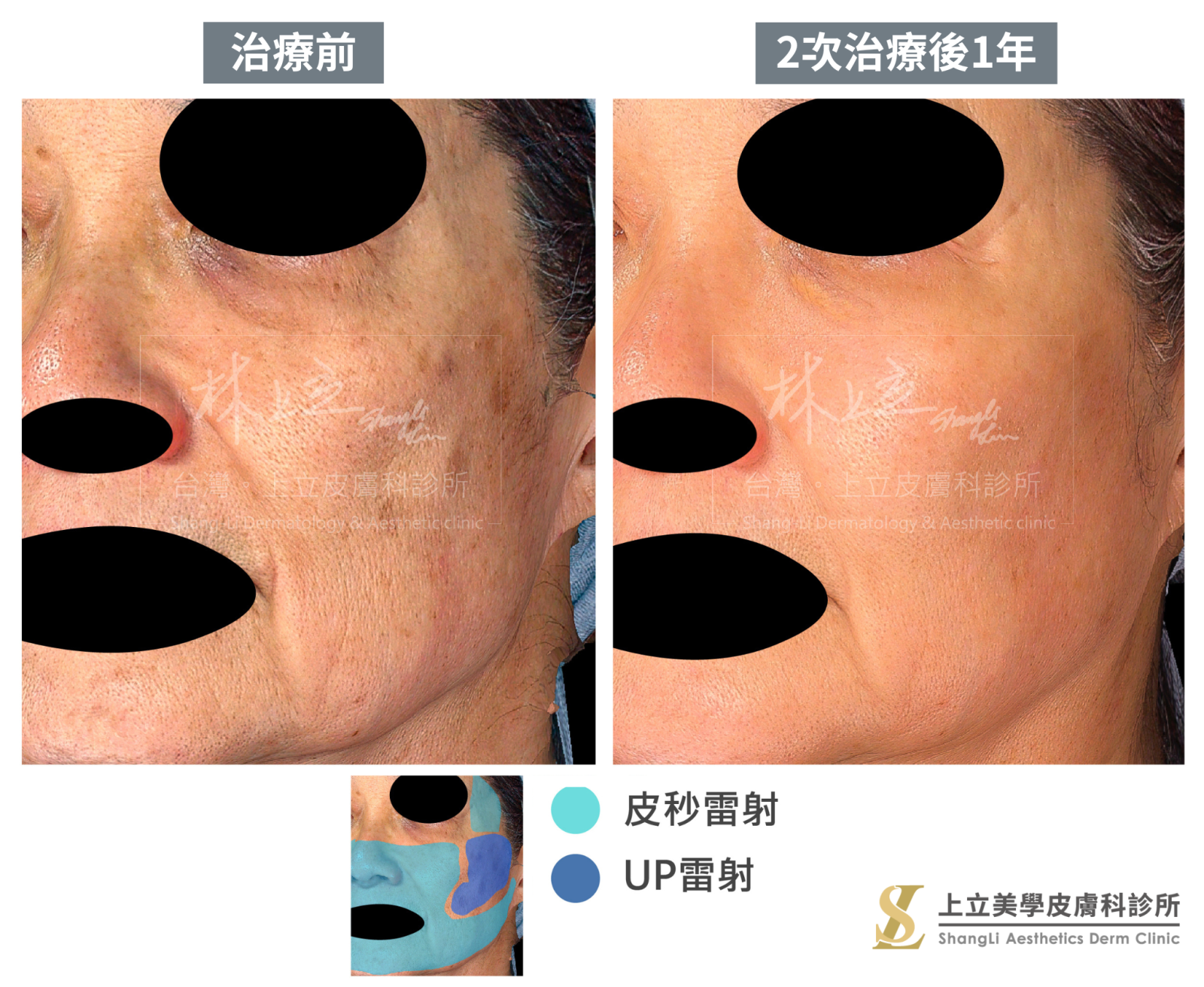 利用PicoSure PRO鉑金蜂巢皮秒雷射大面積改善膚質、縮小毛孔