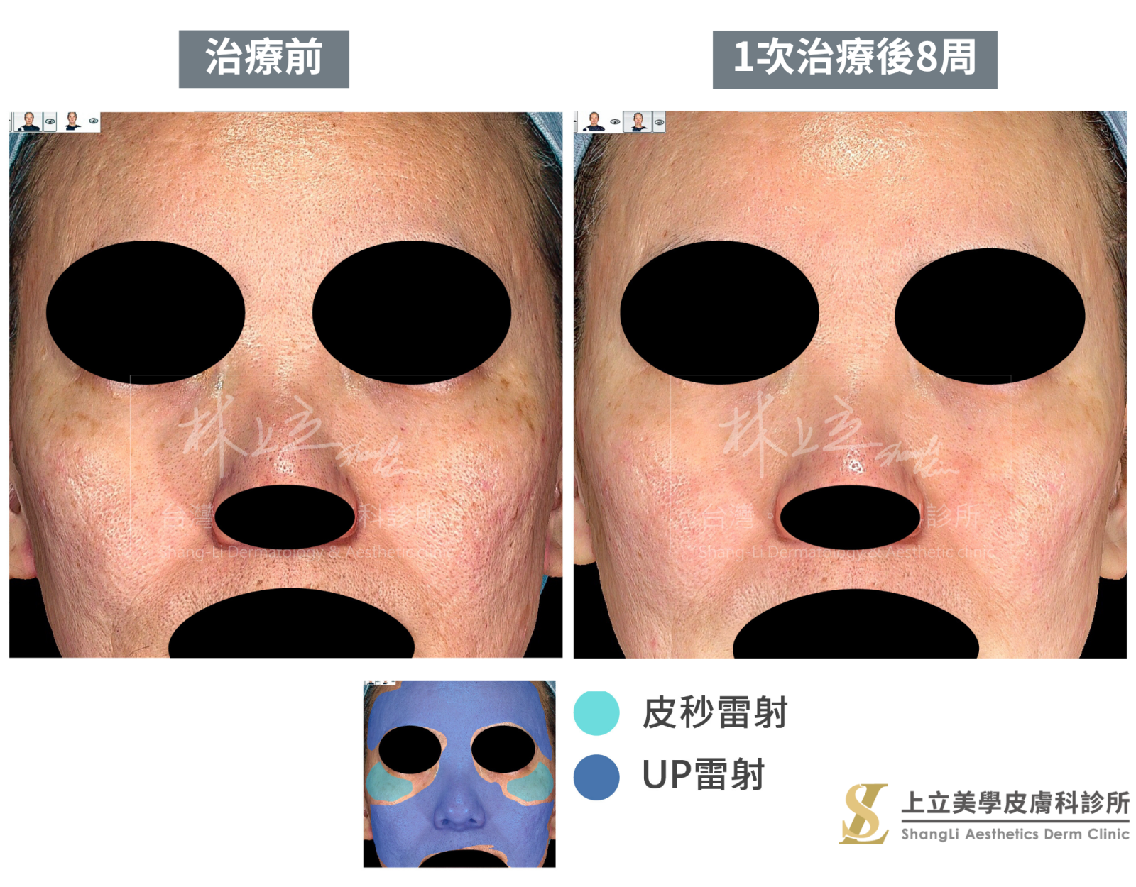 UP雷射和PicoSure PRO鉑金蜂巢皮秒雷射複合治療的案例，但這個案例的主要皮膚問題則源自於更深層的痘疤組織。