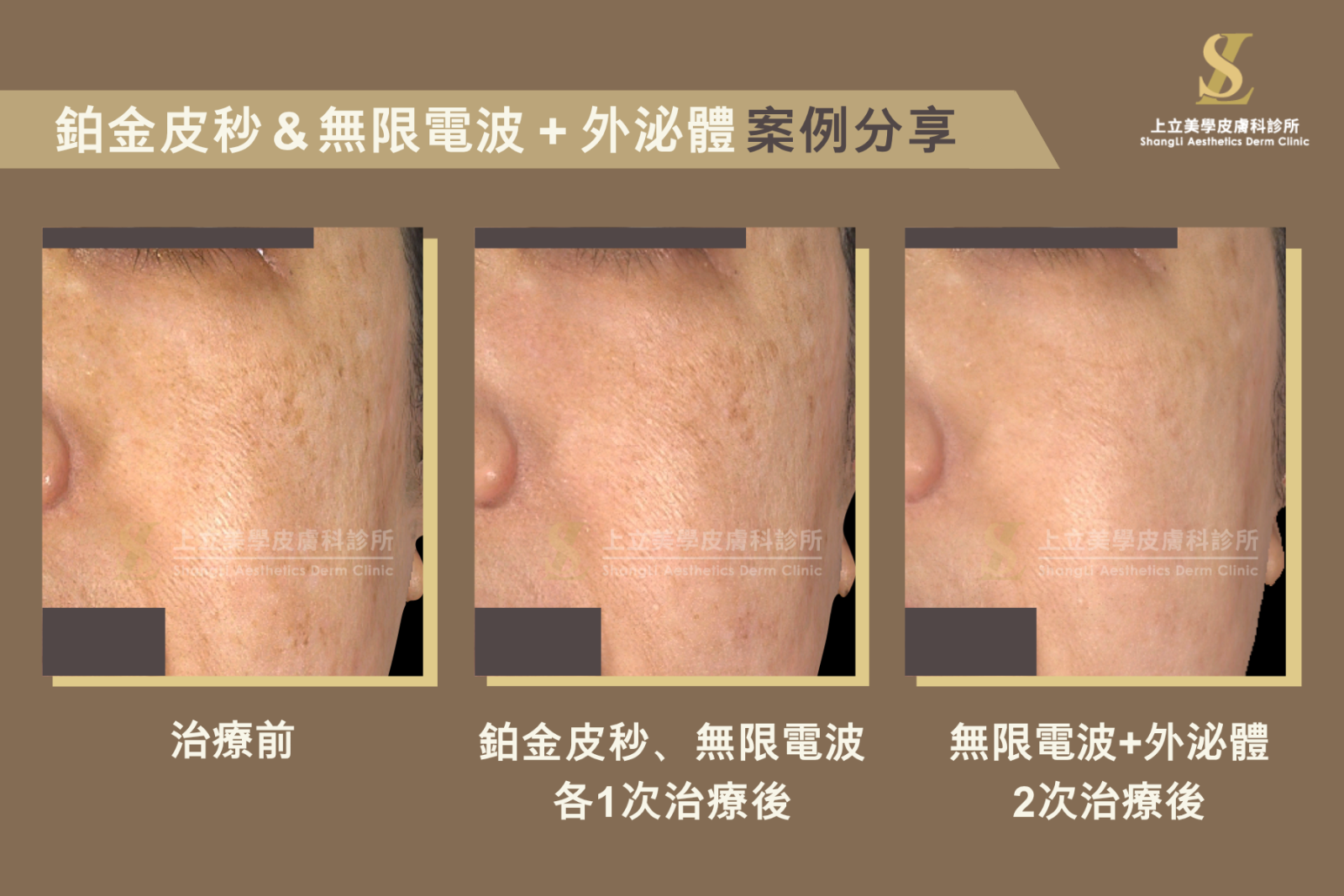 PicoSure PRO 鉑金蜂巢皮秒雷射大範圍淡化色素、提亮膚色並促進真皮層的膠原蛋白新生，改善細紋毛孔