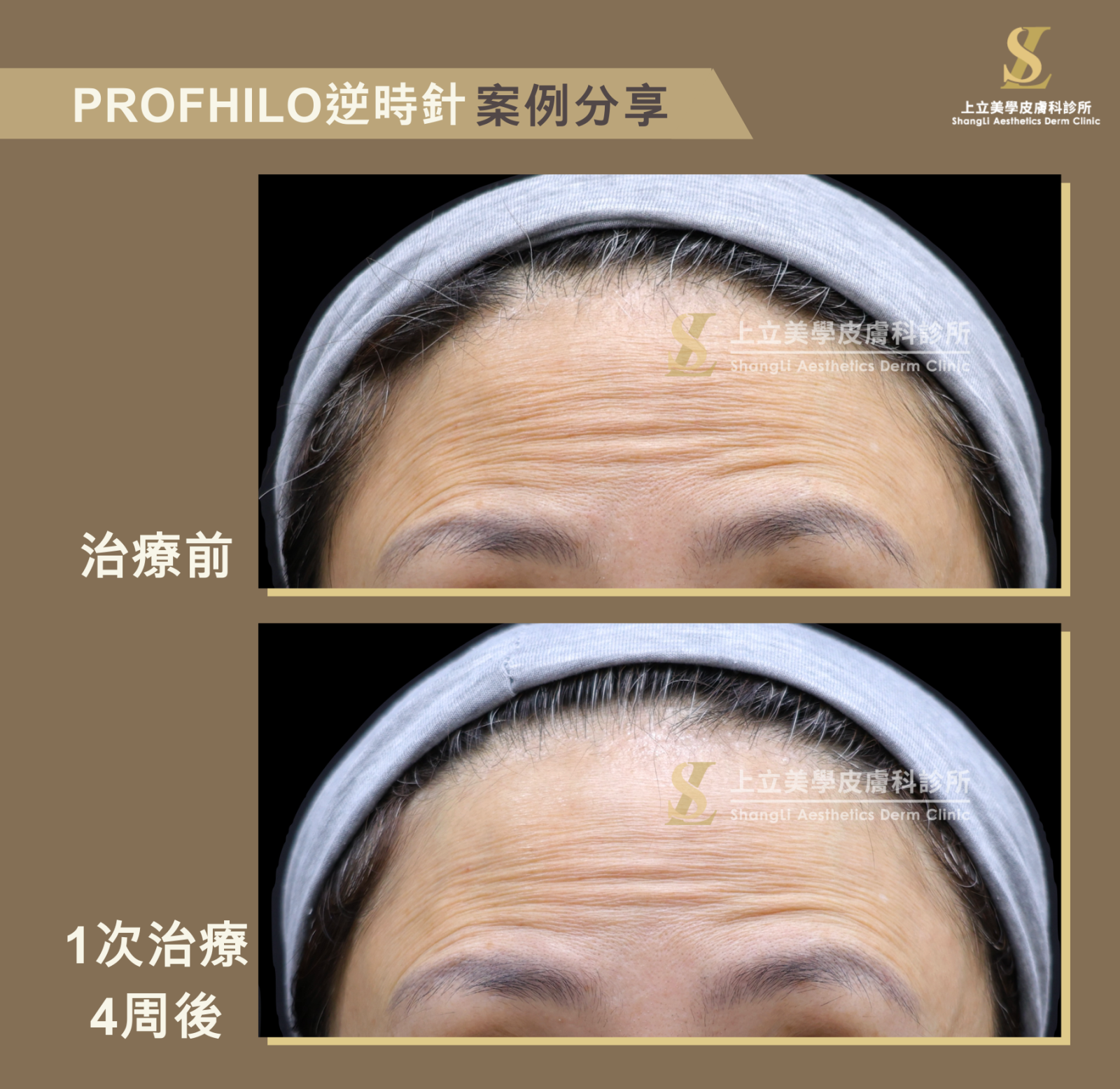 額頭彈力提升，動態抬頭紋變淺