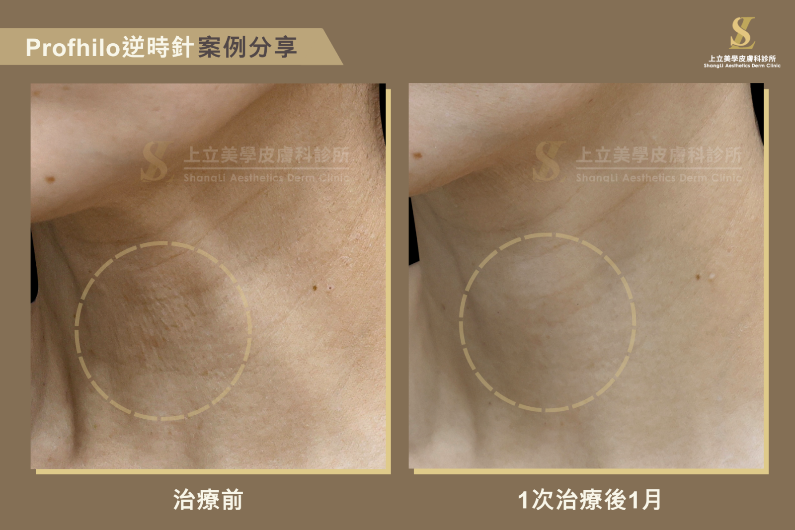 頸部細紋淡化，膚質更平滑細緻