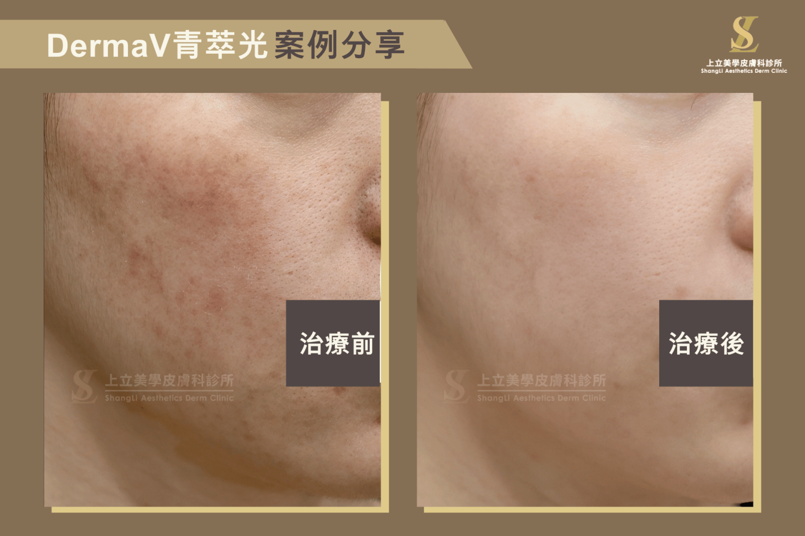 大面積泛紅混雜些許暗沉