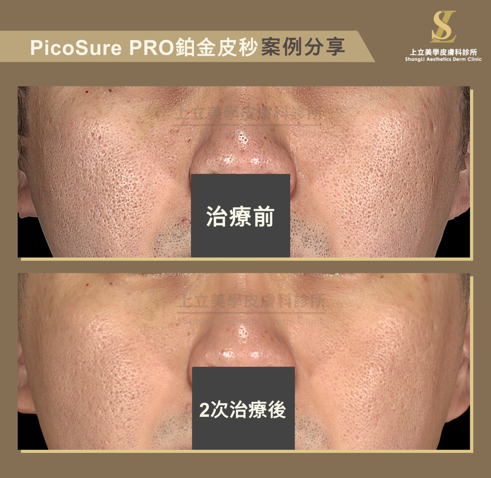 PicoSure PRO鉑金蜂巢皮秒雷射針對淺層凹疤有很好的改善效果，可見在2次治療後，這位求診者的整體膚質平滑度提升許多，一些比較明顯的毛孔與淺層凹疤都有不小的改善。