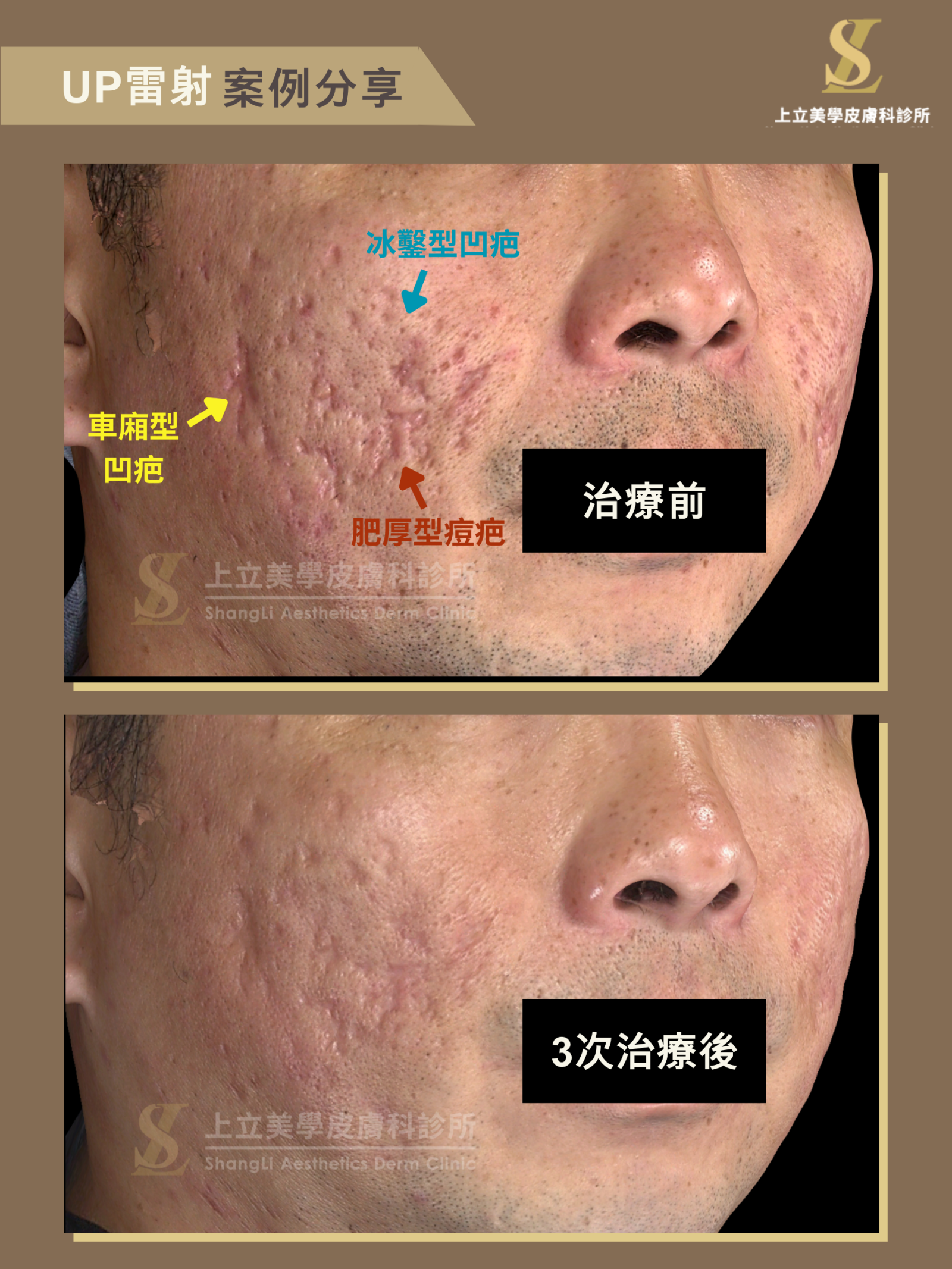 針對深度較深、同時混合了凹疤和凸疤的痘疤型態，UP雷射都能給予有效治療。上圖為UP雷射3次治療後的追蹤效果，可見原先大面積的嚴重痘疤都有很大的進步了。