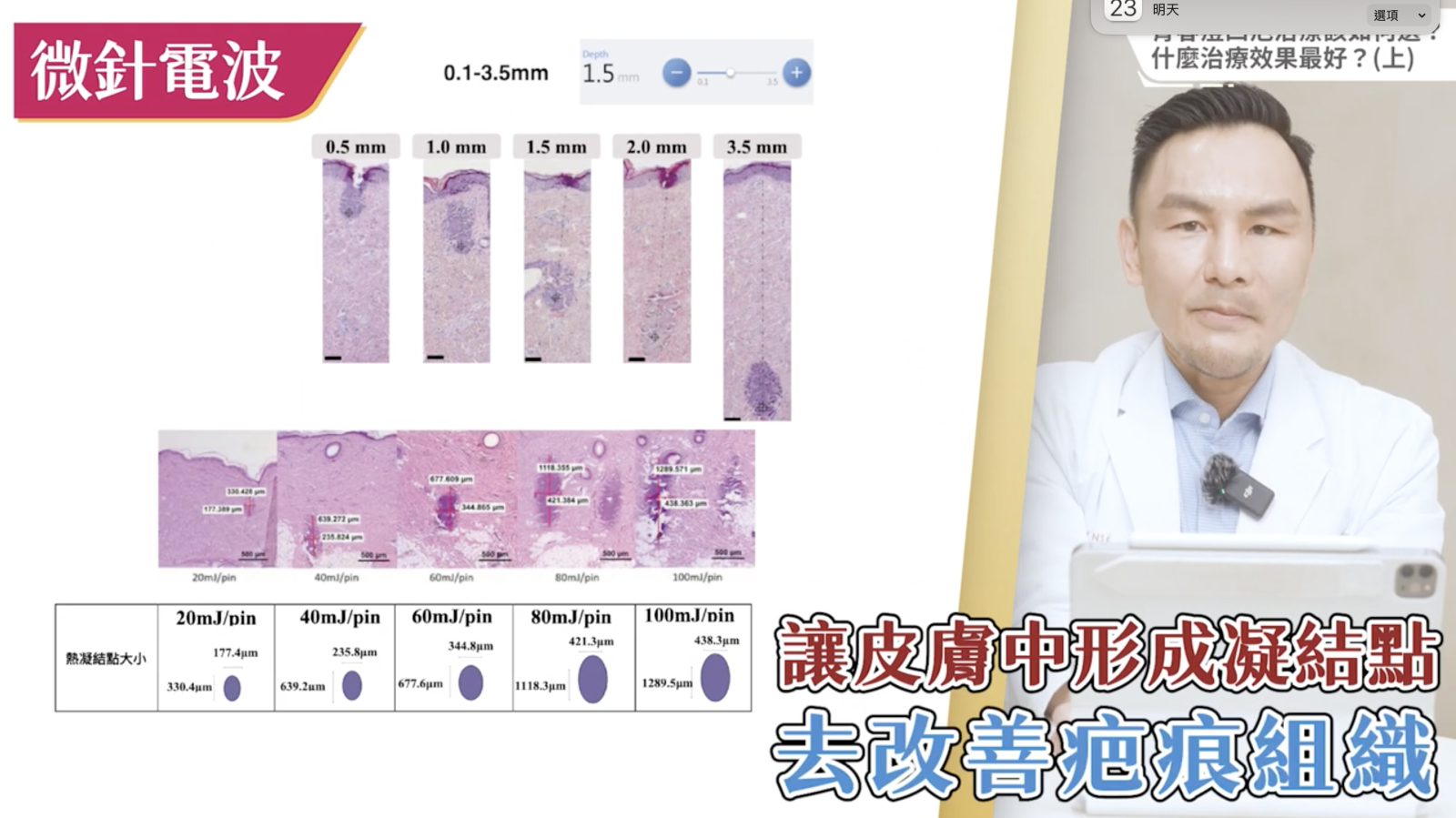 Genius精靈電波可以提供相對靈活的治療深度(皮下0.1~3.5mm)，因此它對於淺、中、深層的痘疤都能有效解決。